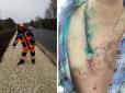 Хрестик на грудях врятував чоловіка від удару блискавки (фото)
